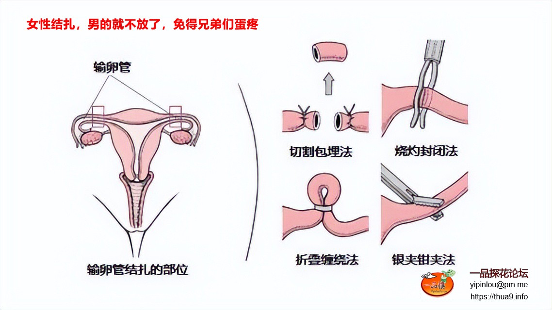 女性结扎方法.jpg